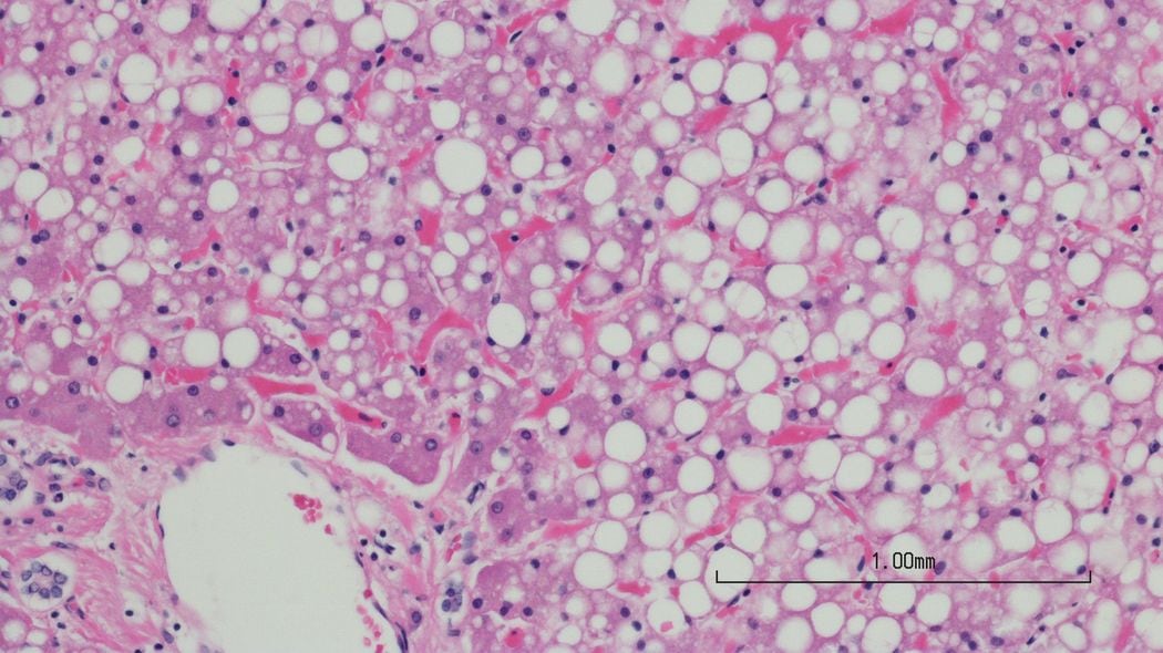 自覚症状はなく､血液診断では判定不能…人間ドックでなければ見つからない｢脂肪肝｣の恐ろしいリスク ｢お酒を飲まない人｣の脂肪肝も増えている