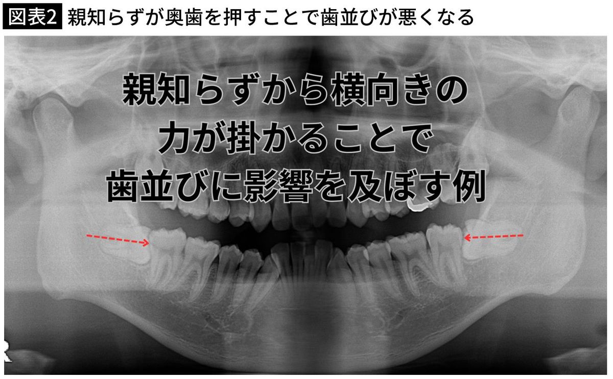 【図表2】親知らずが奥歯を押すことで歯並びが悪くなる