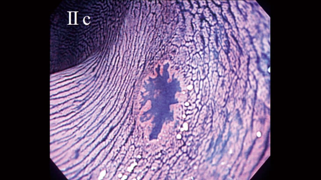 ｢大腸ポリープが10個ある｣よりずっと危険…命を左右する｢へこんだ大腸がん｣が見逃されてしまうワケ どんなに小さくても､速いスピードで進行がんになる