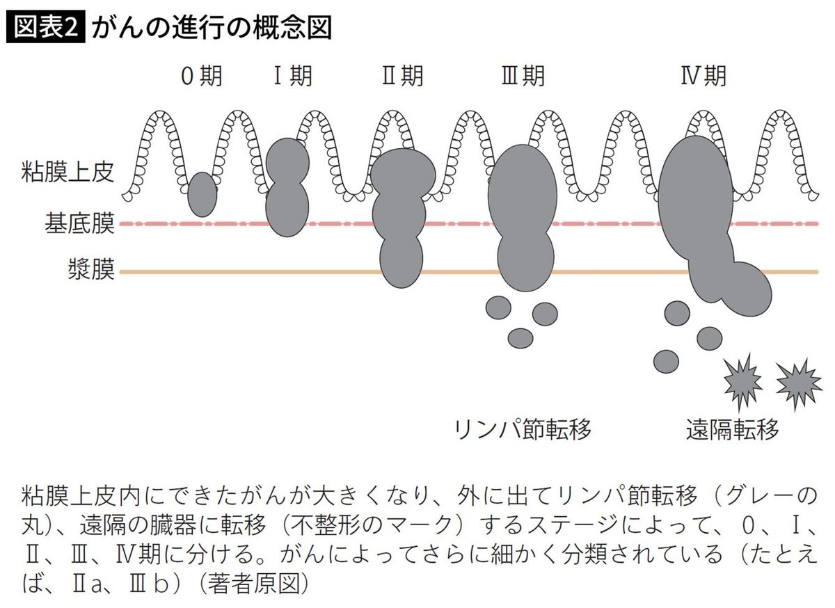 がんの進行の概念図