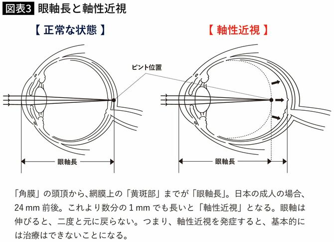 【図表】眼軸長と軸性近視