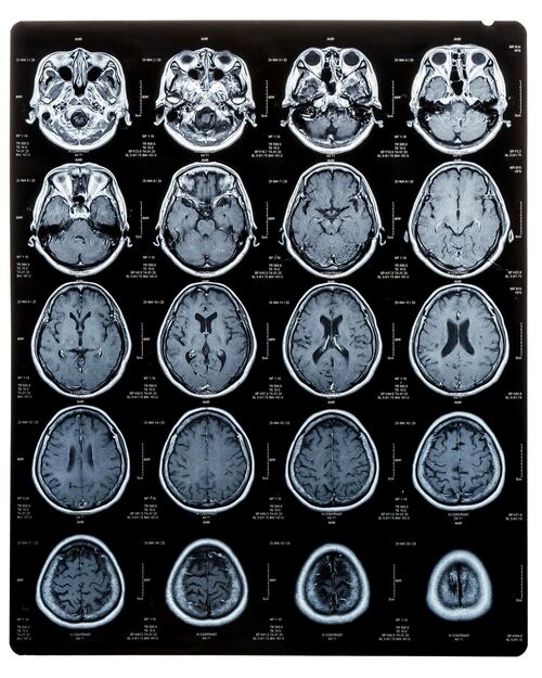 MRIの脳スキャン