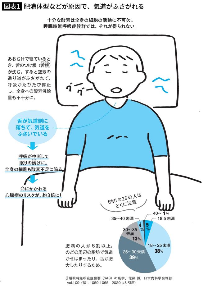 肥満体型などが原因で、気道がふさがれる