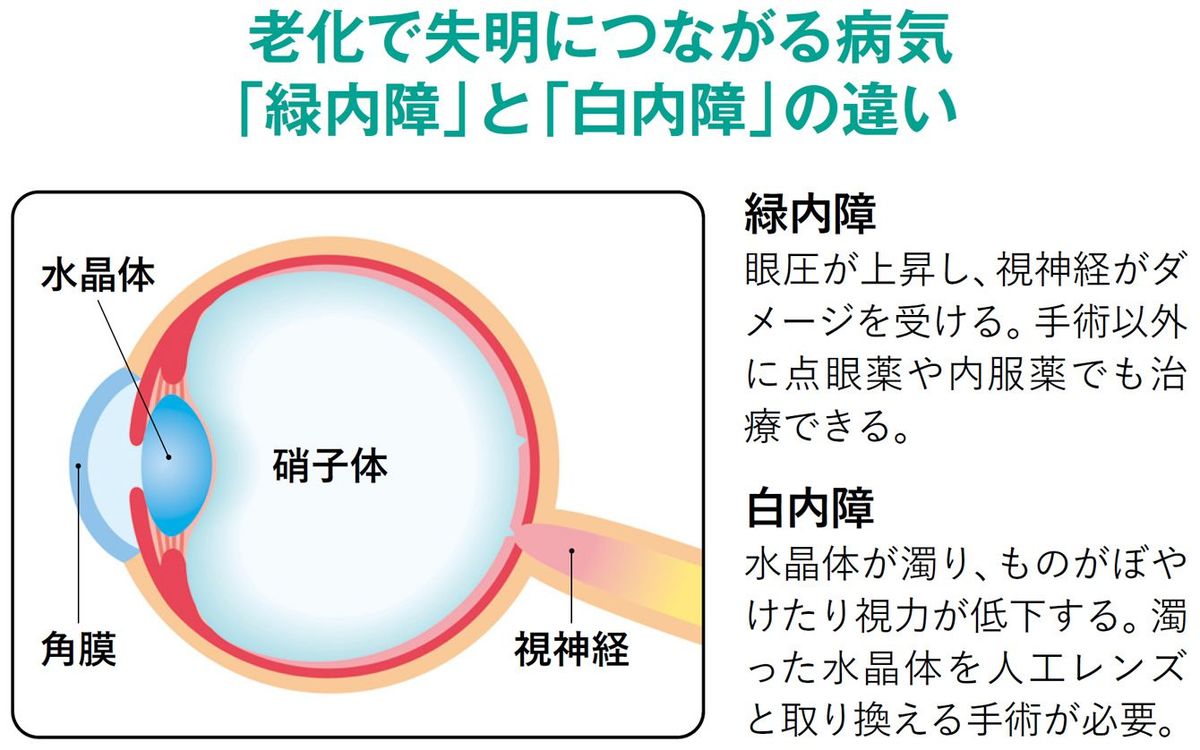 【図表】老化で失明につながる病気「緑内障」と「白内障」の違い