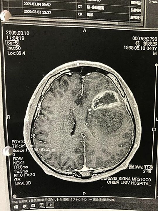 脳の画像は下からとるので左右が逆になる。桂禎次郎の2009年3月10日のMRI画像。左脳にある白い環は「リングエンハンス」とい、膠芽腫の典型的な画像。