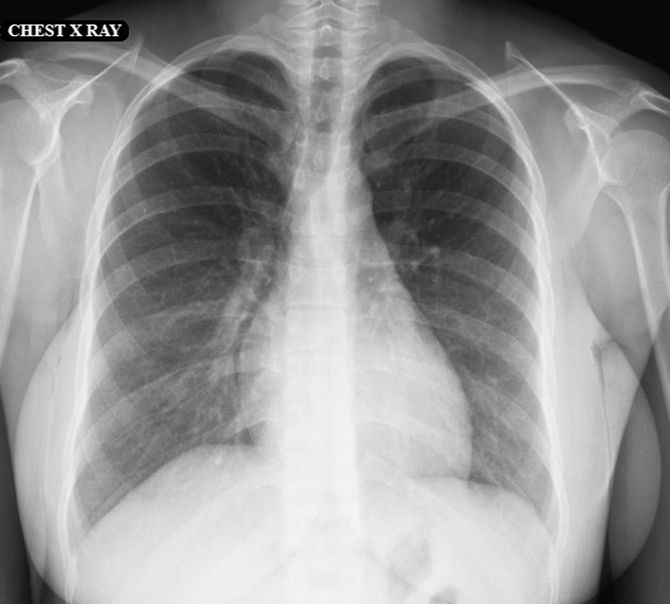 胸郭と腹部のCTスキャン