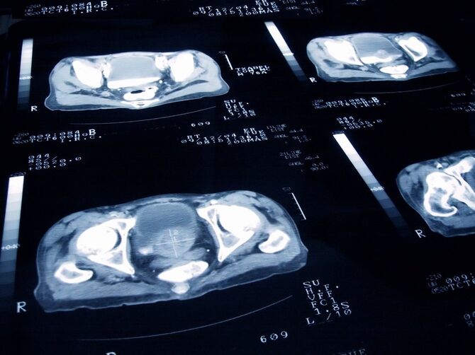 前立腺がんの画像診断