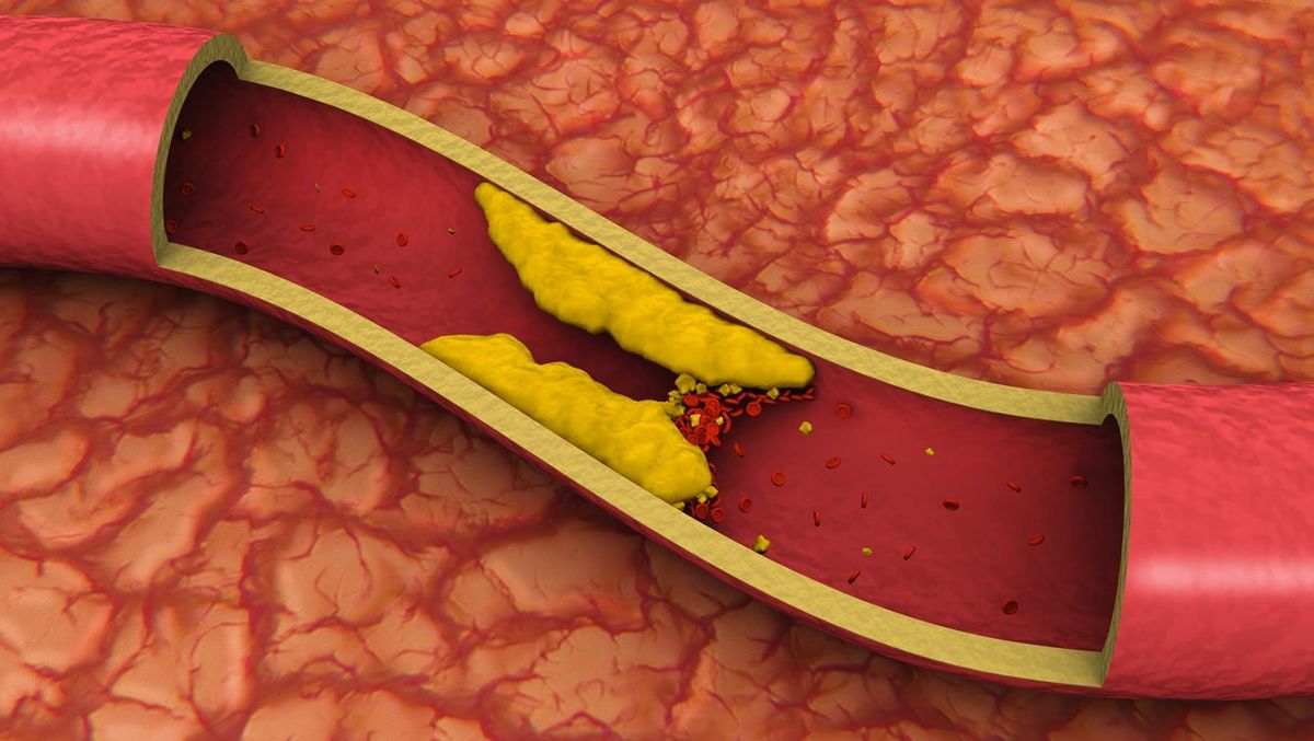 動脈硬化を起こしている血管のイメージ
