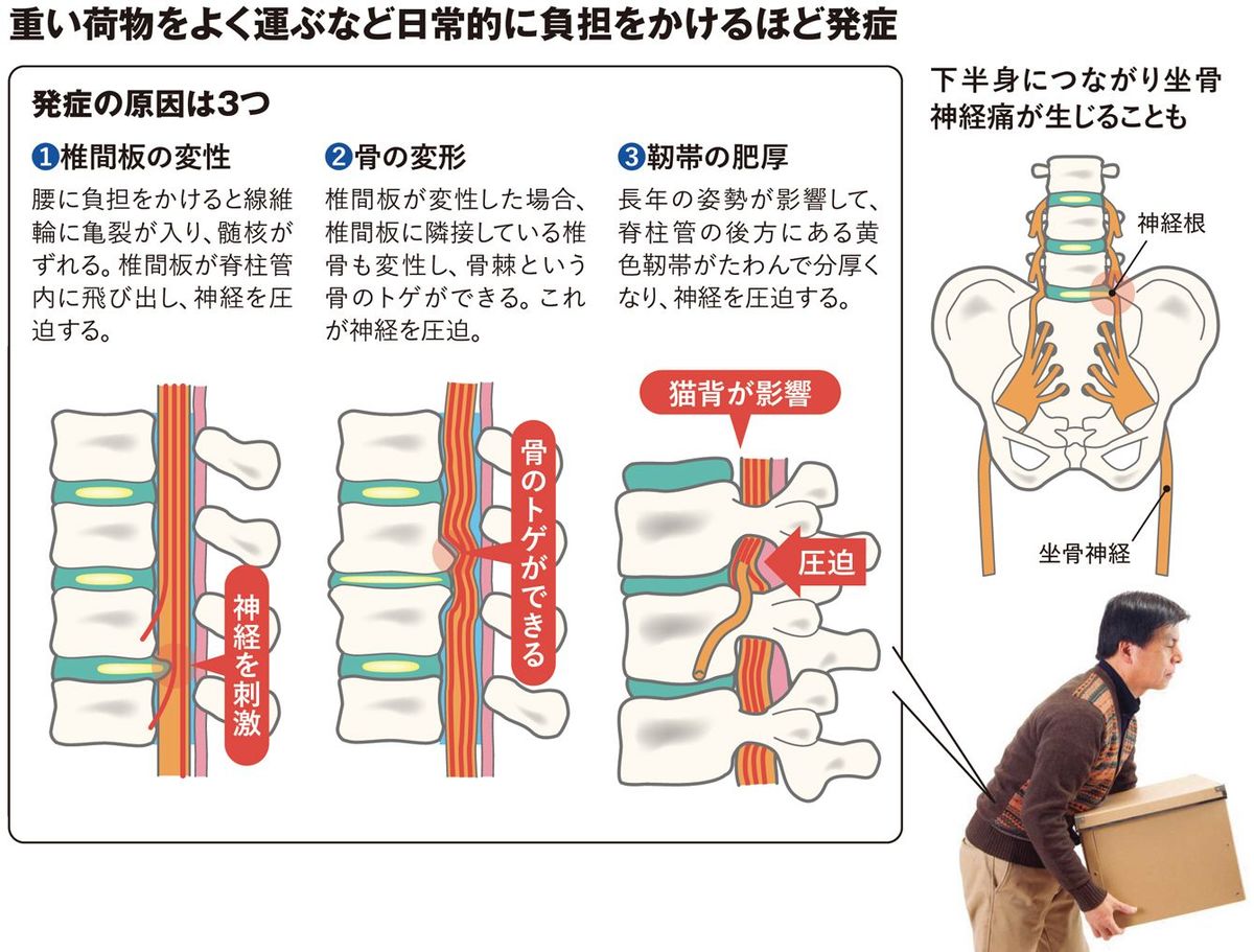 脊柱管狭窄症､椎間板ヘルニア､ぎっくり腰､変形性腰椎症､筋・筋膜性腰痛