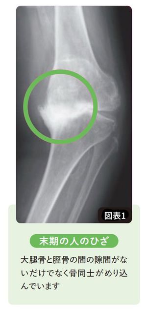 【図表】末期の人のひざ