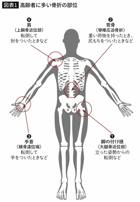 高齢者に多い骨折の部位
