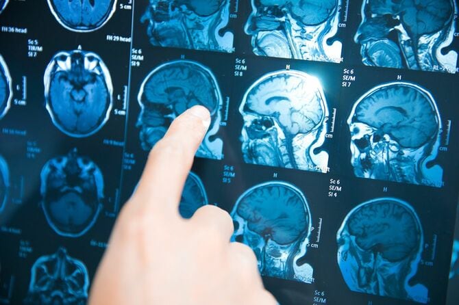 頭部のMRI画像頭部を指さす手元