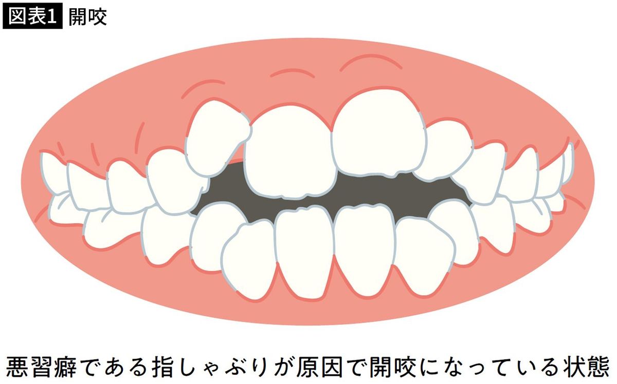 【図表1】開咬