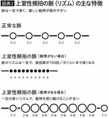 【図表2】上室性頻拍の脈（リズム）の主な特徴