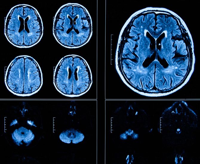 MRI スキャンヒトヘッド断層撮影