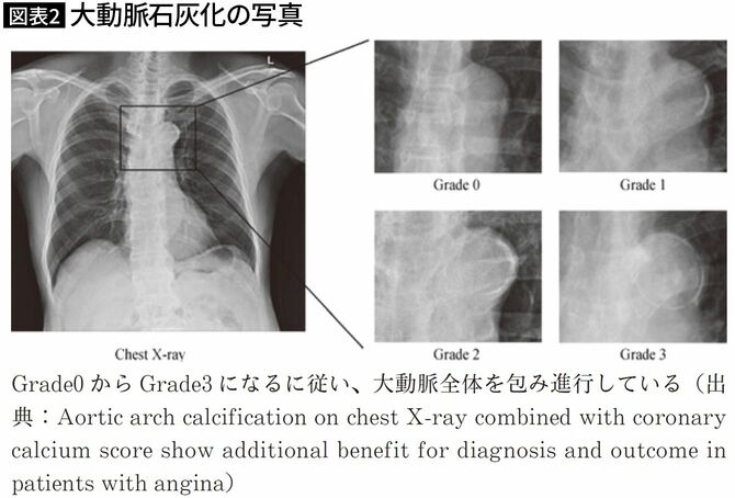 大動脈石灰化の写真