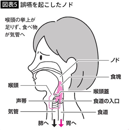 【図表5】誤嚥を起こしたノド