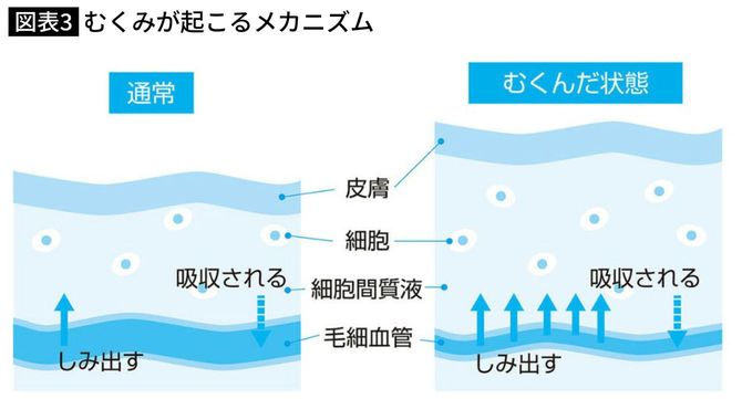 むくみが起こるメカニズム