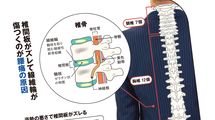 脊柱管狭窄症､椎間板ヘルニア､ぎっくり腰､変形性腰椎症､筋･筋膜性腰痛…【腰痛】原因と対策