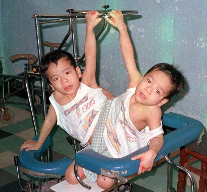 1986年4月、ホーチミン市のツーズー病院で日本から贈られた特製車いすで遊ぶベトちゃん(右)とドクちゃん(左)