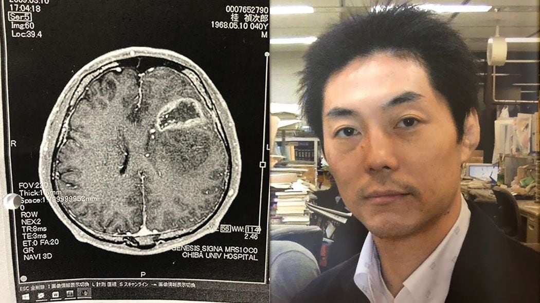 会話をしながら｢むき出しの脳｣よりがんを切除…41歳の新聞記者が命をかけた｢覚醒下手術｣の壮絶 手術は大成功だったが､職場復帰から7カ月で死去