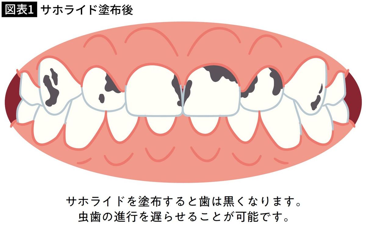 【図表1】サホライド塗布後