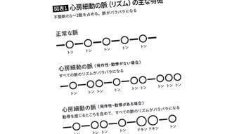 ｢トン-トントン｣と乱れる脈に要注意…長嶋茂雄､小渕恵三元総理の脳梗塞につながった｢心房細動｣の危険信号