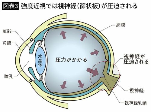 【図表3】強度近視では視神経（篩状板）が圧迫される