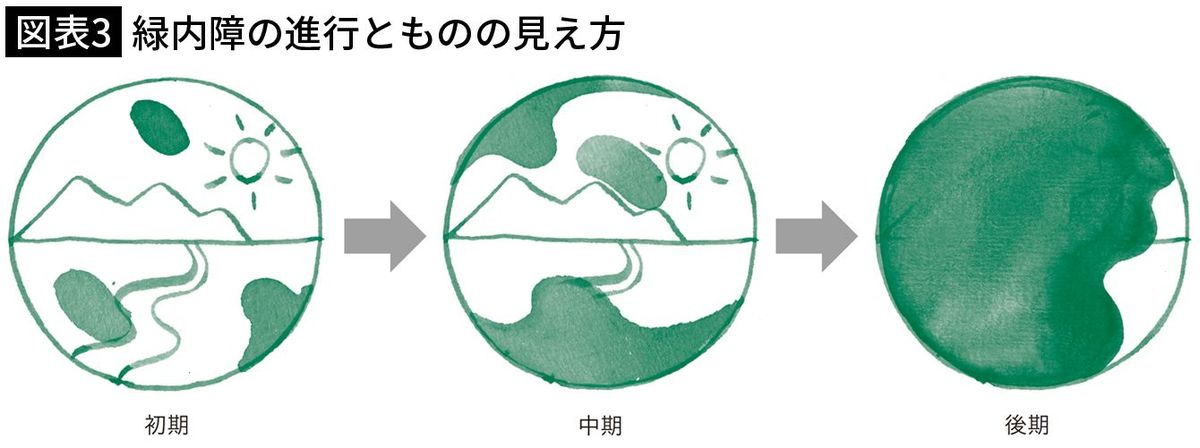 【図表3】緑内障の進行とものの見え方