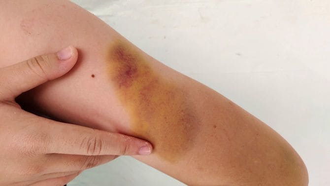 腕の打撲傷と怪我