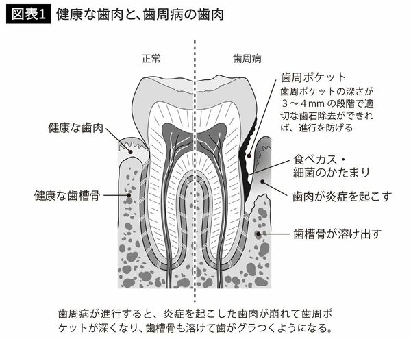 健康な歯肉と、歯周病の歯肉