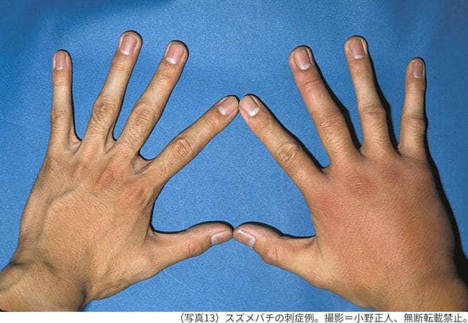 （写真13）スズメバチの刺症例。撮影＝小野正人、無断転載禁止。