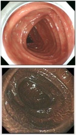 上は正常な状態の大腸。下は長期間刺激性下剤を服用していたため、メラノーシスで真っ黒になった便秘患者の大腸