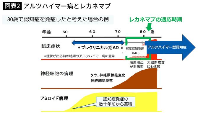アルツハイマー病とレカネマブ
