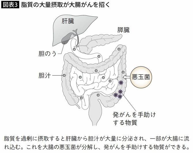 脂質の大量摂取が大腸がんを招く