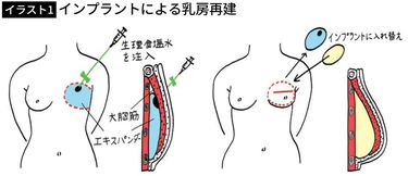 命が助かったのだから乳房がなくても仕方ない｣韓国で5割超の乳房再建率
