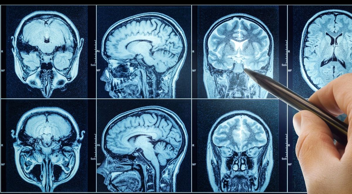 CTスキャンした脳の写真を指す医者の手とペン