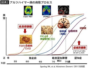 4割の人は使えない…アルツハイマー型認知症早期治療の期待の新薬
