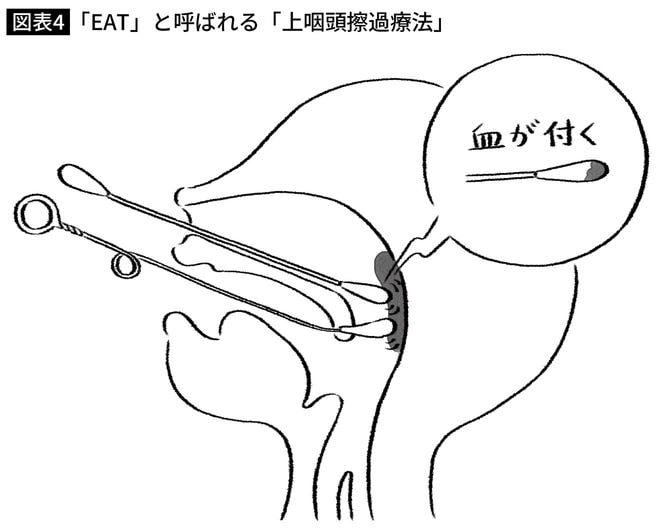 「EAT」と呼ばれる「上咽頭擦過療法」