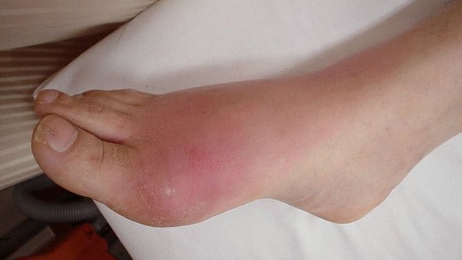 痛風発作の患部写真