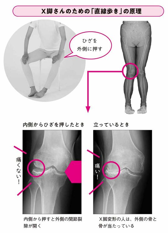 【イラスト】X脚さんのための「直線歩き」の原理