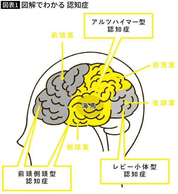 【図表】図解でわかる 認知症