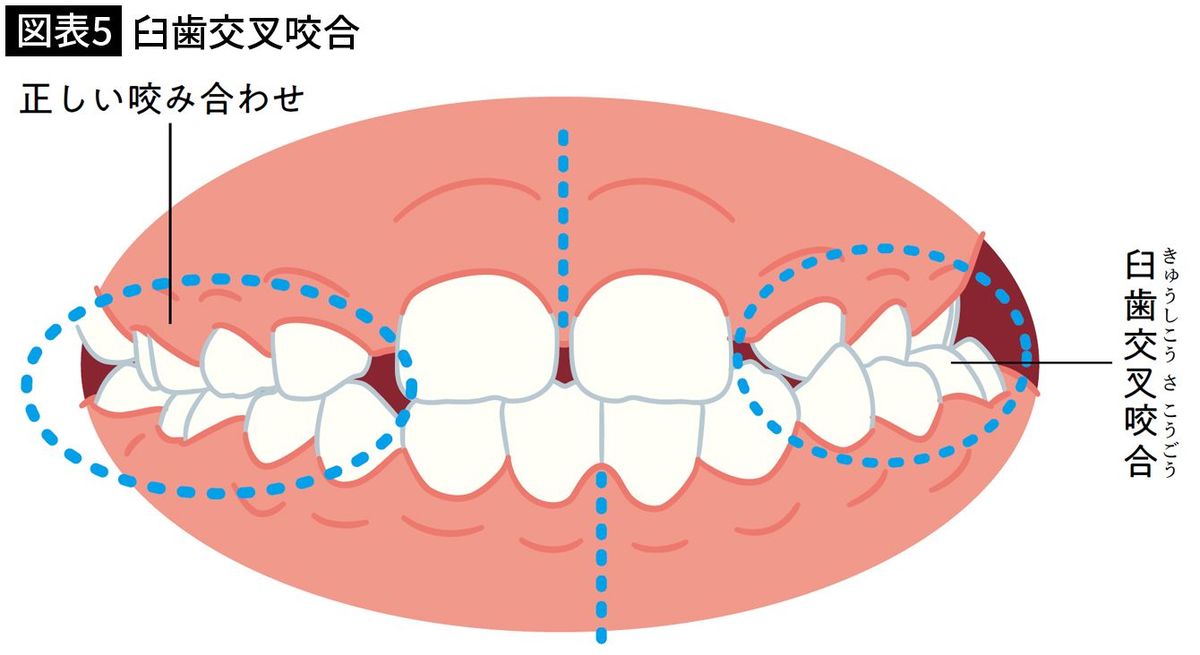 【図表5】臼歯交叉咬合