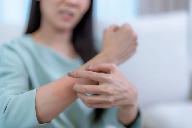 腕にできた蕁麻疹をかく人