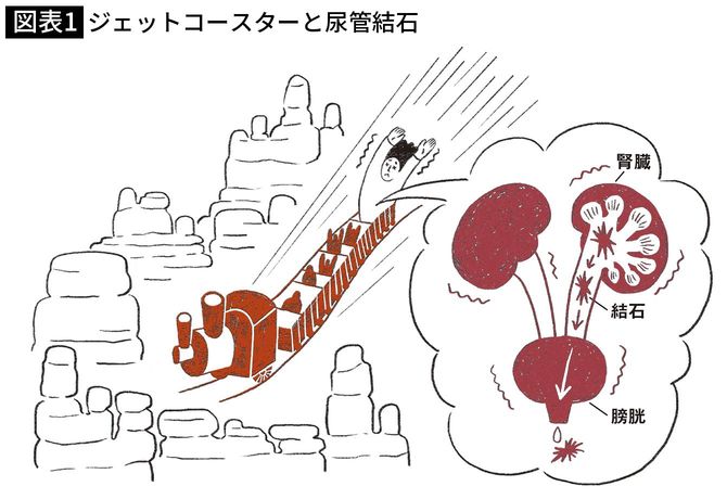 【図表1】ジェットコースターと尿管結石