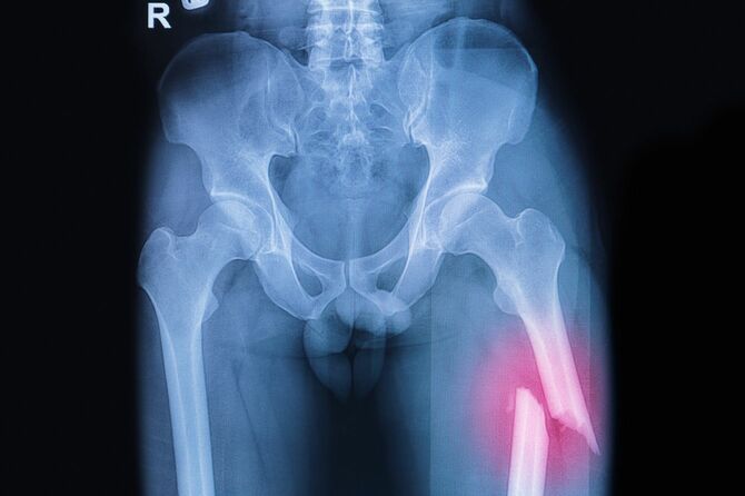 大腿骨骨折のレントゲン写真