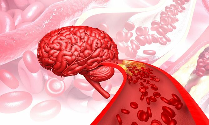 脳の血管の詰まりのイメージ