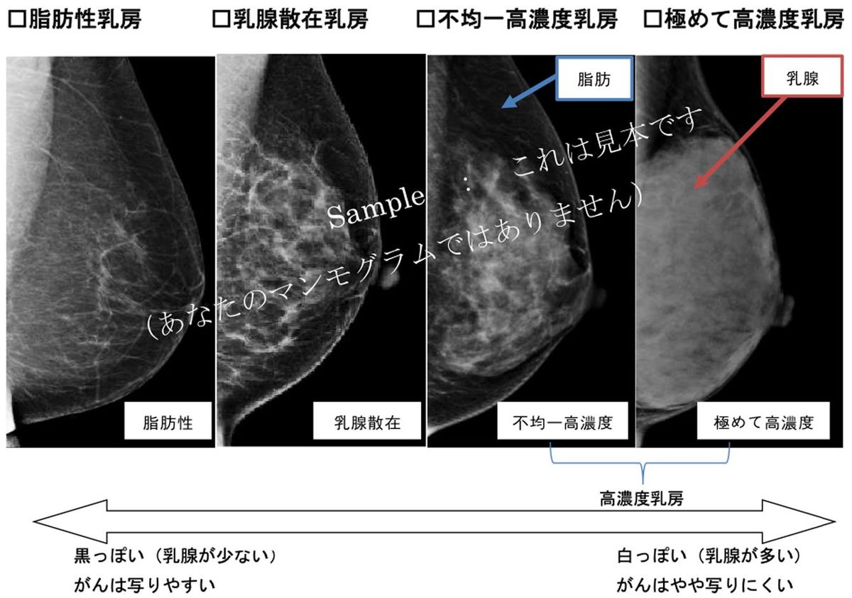 マンモグラフィ検査のイメージ
