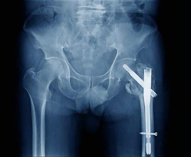 大腿骨骨折治療中のレントゲン写真