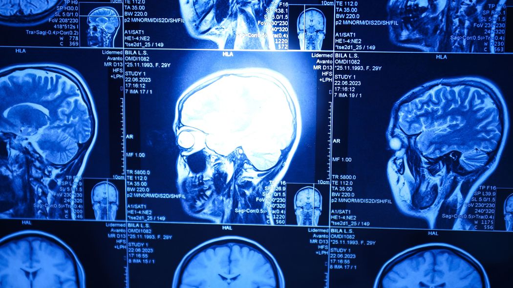 アルツハイマー病から｢逃げおおせる人｣は食事が違う…長寿研究の医師が口に入れたくない｢米､塩､肉｣の種類 アルツハイマー病対策の第一人者が毎日食べたい必須の食材